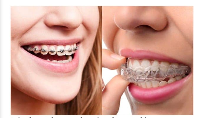 Braces