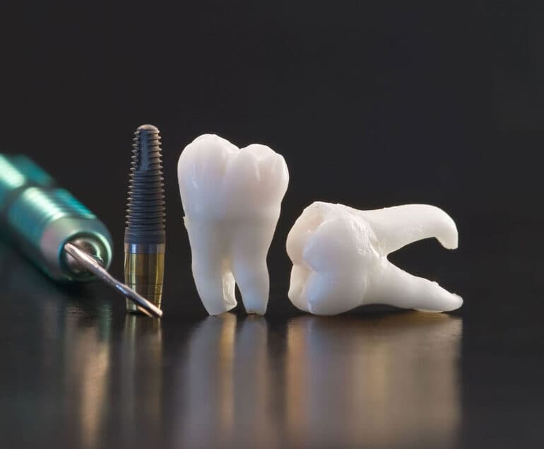 RCT / Root Canal