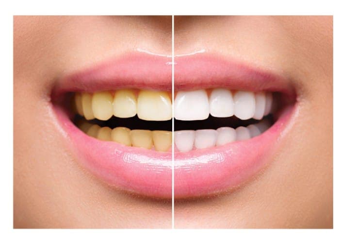 Teeth Whitening