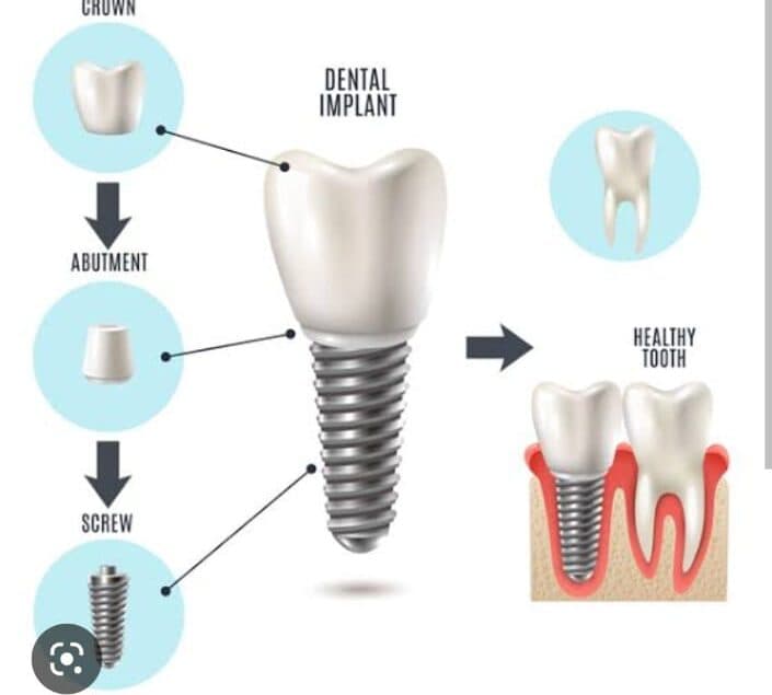 Dental Implants
